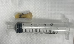 Gắp chiếc răng của cụ ông bị đột quỵ não rơi vào đường thở