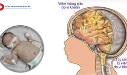 Cứu bé 20 ngày tuổi nguy kịch do viêm não mô cầu