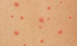 Cẩn trọng với bệnh thủy đậu g&#226;y biến chứng