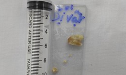 Hạt lạc mắc trong phế quản, cụ &#244;ng ho dai dẳng 