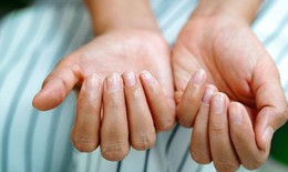 Bổ sung vitamin và khoáng chất nào khi móng tay giòn, dễ gãy?