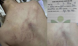 Cục Bà mẹ và Trẻ em lên tiếng về vụ trẻ bị bạo hành ở Hà Nội