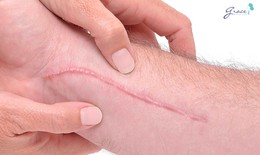 Ki&#234;ng g&#236; để tr&#225;nh bị sẹo lồi?