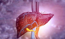Xơ gan do rượu v&#224; c&#225;c dấu hiệu cảnh b&#225;o cần biết