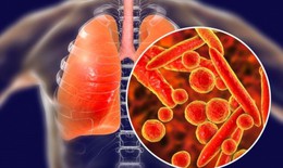 Những dấu hiệu cảnh báo sớm bệnh lao phổi bạn không nên bỏ qua