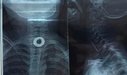 Nội soi gắp chiếc long đen mắc trong thực quản b&#233; 7 tuổi