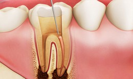 Điều trị lấy tuỷ buồng cho răng viêm tuỷ có tổn thương quanh chóp: Cơ hội giữ lại tuỷ sống cho răng