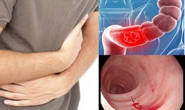 Phát hiện mắc ung thư sau 3 tháng rối loạn tiêu hóa