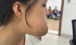 Phẫu thuật loại bỏ khối u, lấy lại thẩm mỹ khu&#244;n mặt cho c&#244; g&#225;i 16 tuổi