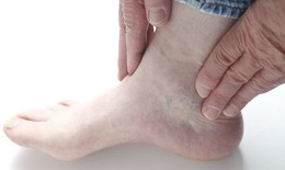 Biểu hiện biến chứng thận ở bệnh nhân tiểu đường
