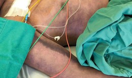 Người cao tuổi mắc liên cầu khuẩn lợn ở Hà Nội