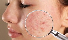 Bôi kem đánh răng có giúp điều trị mụn trứng cá?