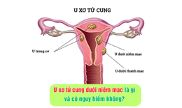 U xơ tử cung dưới ni&#234;m mạc l&#224; g&#236; v&#224; ảnh hưởng sức khỏe thế n&#224;o?
