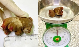 Vi&#234;n sỏi thận &#39;khổng lồ&#39; như san h&#244; nằm trong cơ thể người đ&#224;n &#244;ng gần 20 năm