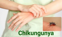 Bệnh Chikungunya: Nguyên nhân, triệu chứng, cách điều trị và phòng bệnh