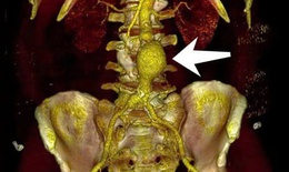 Cảnh gi&#225;c với ph&#236;nh động mạch chủ khi bệnh kh&#244;ng c&#243; biểu hiện r&#245; r&#224;ng