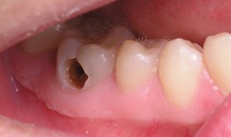 Nhận biết v&#224; đề ph&#242;ng s&#226;u răng ở trẻ