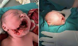 Những nỗ lực chăm sóc bà mẹ, trẻ em ở Lũng Cú và câu chuyện lay động cứu sống bé sơ sinh bị rạch một vết sâu vào má