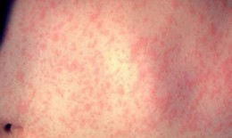 Số ca mắc bệnh sởi tại ch&#226;u Mỹ tăng mạnh