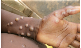 WHO khuyến cáo điều trị HIV sớm cho bệnh nhân đồng nhiễm Mpox