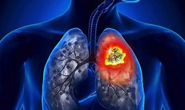 Ung thư phổi đau ở đâu, dấu hiệu cảnh báo căn bệnh này