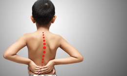 Vẹo cột sống phát hiện như thế nào?