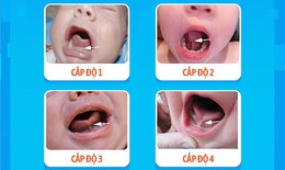 Dị tật bẩm sinh khiến trẻ khó bú, khó phát âm
