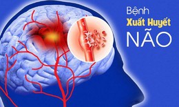 Các loại xuất huyết não và dấu hiệu nhận biết