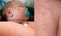 Công dụng làm mát, hỗ trợ phòng rôm sảy từ trà Shan Tuyết vùng cao