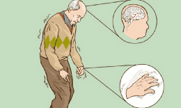 Biểu hiện cho thấy bạn mắc bệnh Parkinson