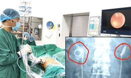 Biến chứng nguy hiểm vì 'quên' ống thông trong người 2 năm