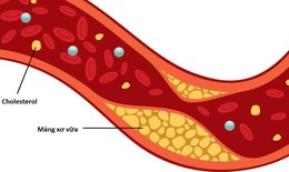 9 cách tự nhiên giúp giảm cholesterol xấu, bảo vệ tim mạch