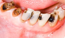 6 dấu hiệu thiếu canxi bạn không nên bỏ qua