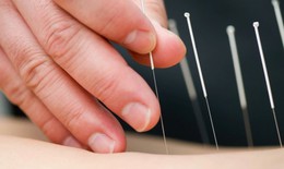Châm cứu để chữa đau lưng