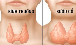 Thiếu i-ốt gây hại như thế nào?