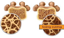 Loãng xương: Dự phòng và điều trị từ lối sống đến thuốc