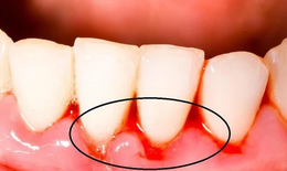 Chảy máu chân răng – Cơ thể cảnh báo điều gì?