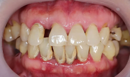 Viêm nha chu ở người cao tuổi: 'Rào cản' chất lượng cuộc sống