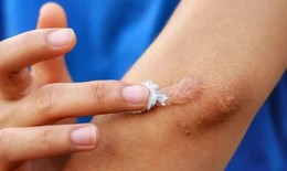 Bộ Y tế đ&#236;nh chỉ, thu hồi to&#224;n quốc, y&#234;u cầu ti&#234;u huỷ 1 loại gel &#39;ngừa sẹo&#39; do vi phạm 3 lỗi