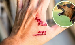 Xử trí vết thương đúng khi bị chó, mèo cắn để phòng bệnh dại