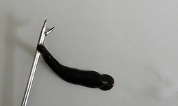 Đỉa d&#224;i 4cm k&#253; sinh trong mũi b&#233; trai suốt 10 ng&#224;y