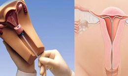 Tr&#225;nh thai nội tiết c&#243; thực sự tốt cho phụ nữ?