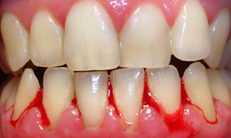 Hành trình 'giải cứu' nướu viêm: Từ thảo dược tự nhiên đến liệu pháp chuyên sâu
