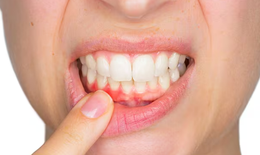 5 sai lầm 'tai hại' khi đánh răng, 'hủy hoại' nướu (lợi) mỗi ngày