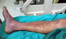 Ca nhiễm liên cầu lợn tăng ở một số nơi, cần biết các khuyến cáo phòng bệnh của Bộ Y tế