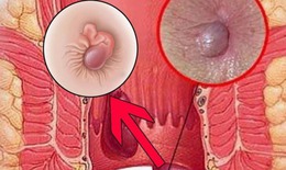 C&#225;ch ph&#226;n biệt bệnh trĩ v&#224; những bệnh hậu m&#244;n để tr&#225;nh nhầm lẫn