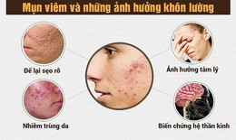 Dùng thuốc và cách chăm sóc da mụn viêm đỏ tại nhà