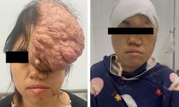 'Giải cứu' cô gái Mông mang khối u khổng lồ 25 × 35 cm vùng đỉnh trán