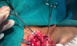 Cứu sống bệnh nh&#226;n bị d&#226;y điện s&#224; giữa đường cứa đứt kh&#237; quản