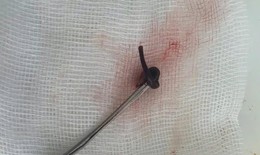 Ph&#225;t hiện con vắt d&#224;i 3cm sống trong mũi c&#244; g&#225;i hơn 1 tuần